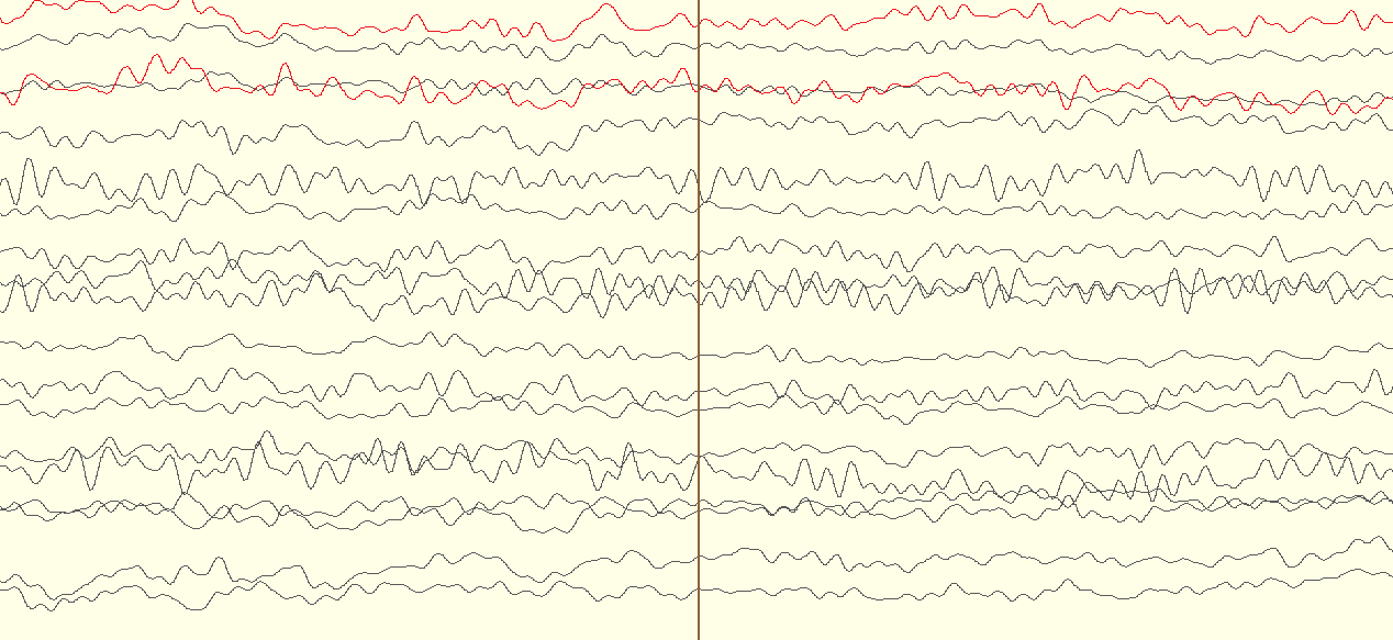 An example of a raw EEG