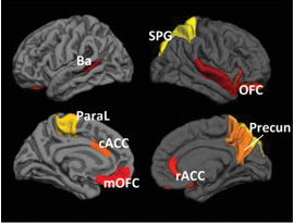 Comparing between twins allows us to determine the relative contribution of genetics and environment to changes in the volume of grey matter in different parts of the brain. Changes are highlighted in colour. (Gatt et al 2012, Twin Research and Human Genetics)